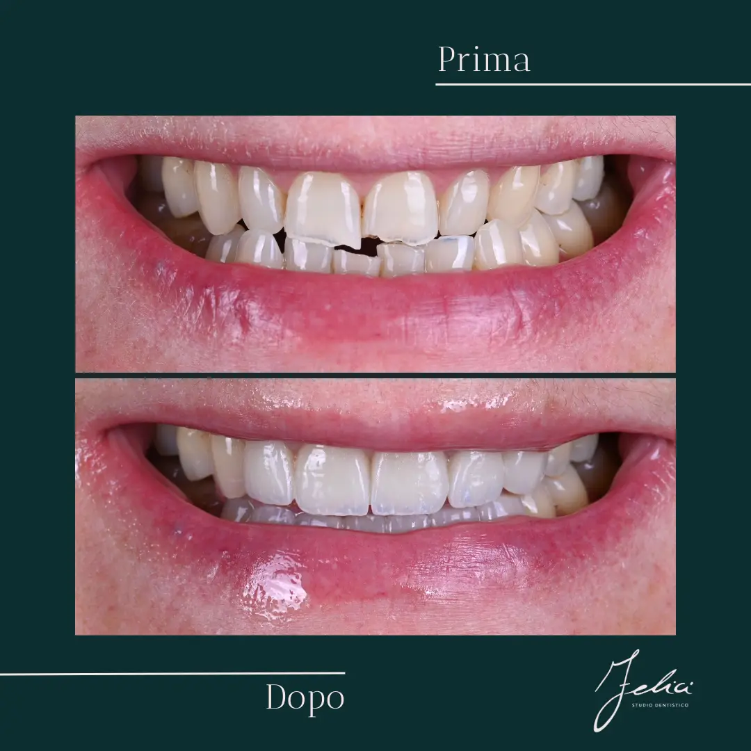 Faccette dentali - caso clinico