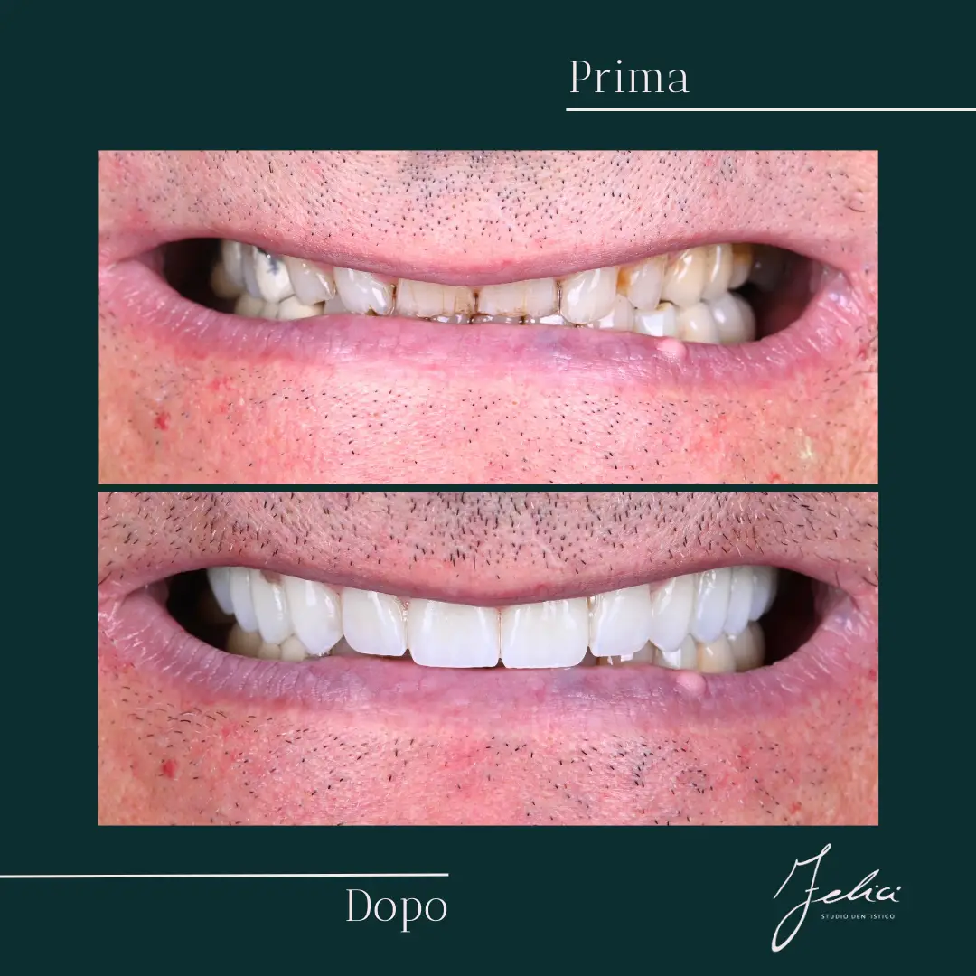 Faccette dentali - caso clinico