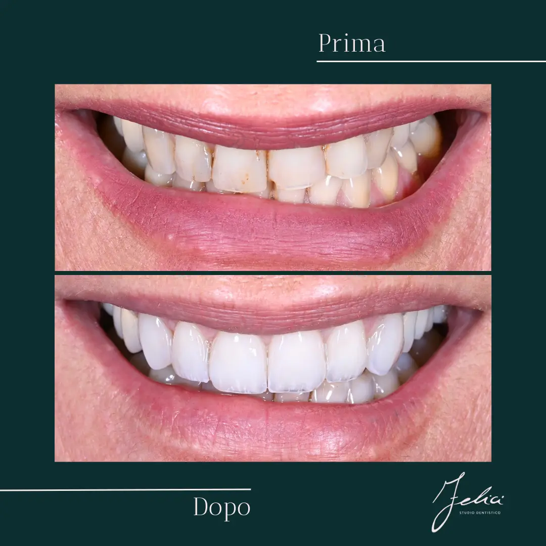 Faccette dentali - caso clinico