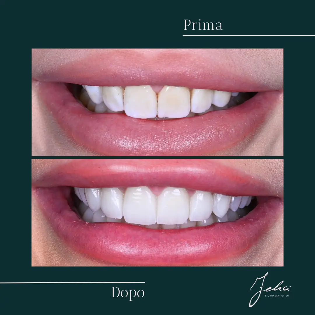 Faccette dentali - caso clinico