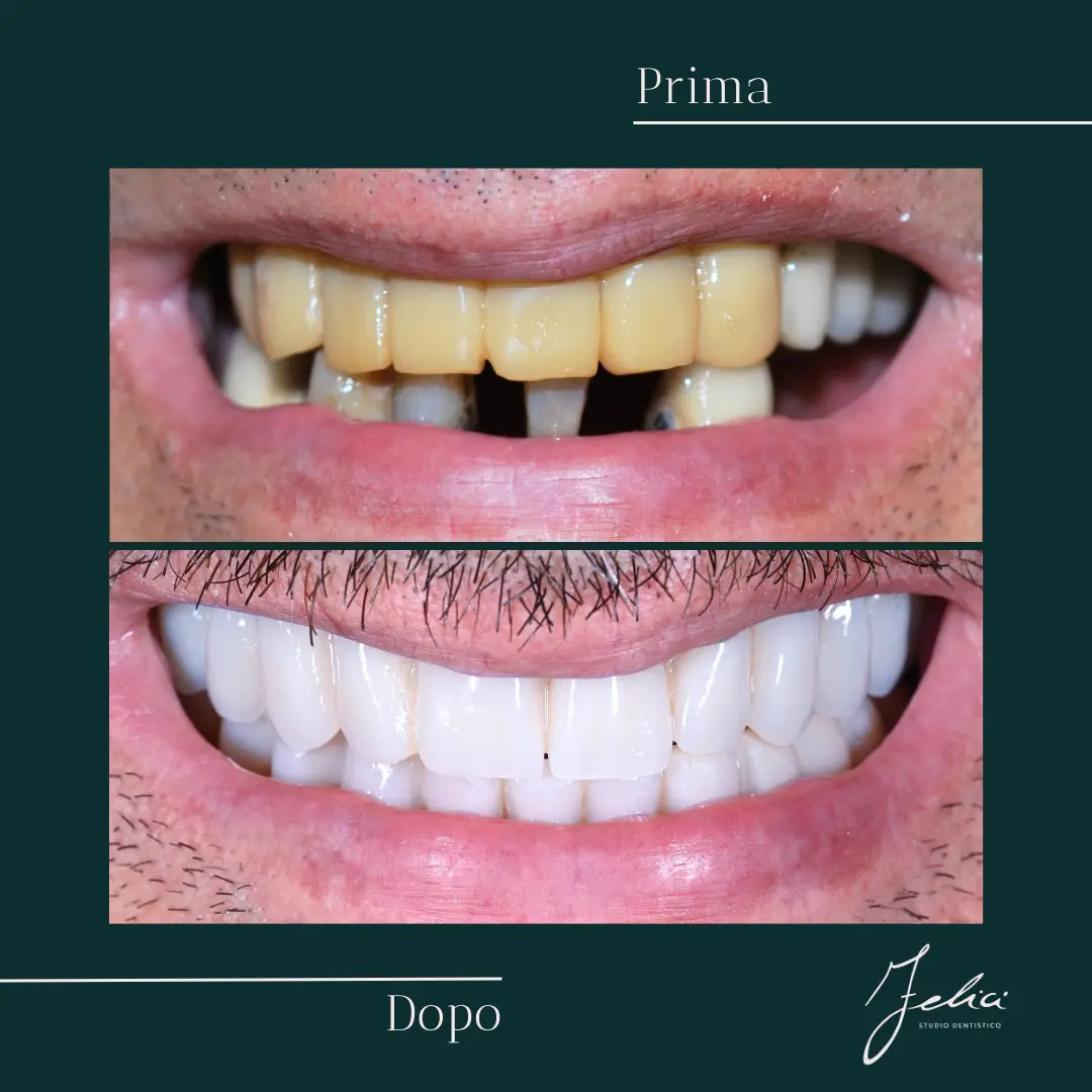 Implantologia - caso clinico