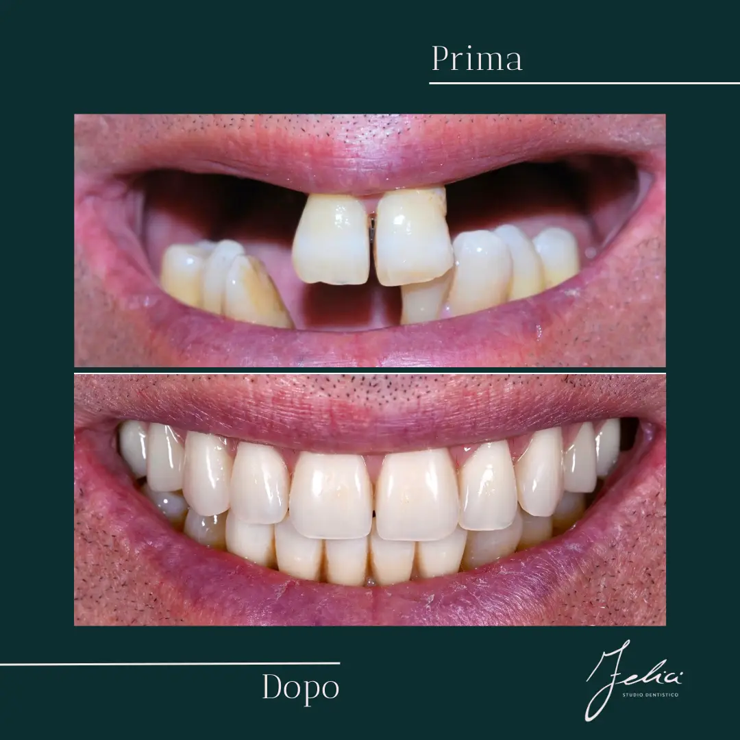 Implantologia - caso clinico