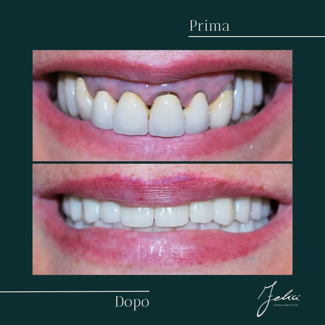 Implantologia - caso clinico