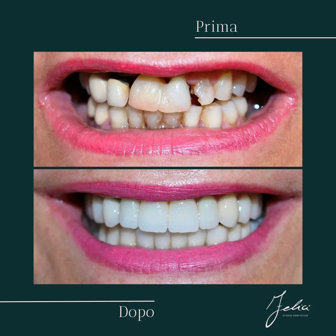 Implantologia - caso clinico